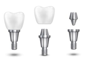 Implante dentário